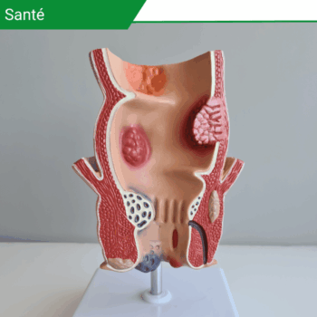 Cancer de l&rsquo;anus, signes alarmants