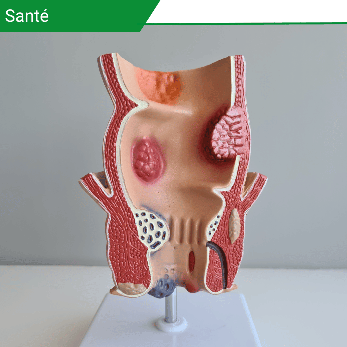 Cancer de l&rsquo;anus, signes alarmants