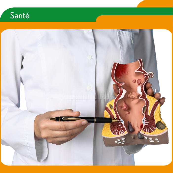 Cancer colorectal, du rectum versus de l’anus